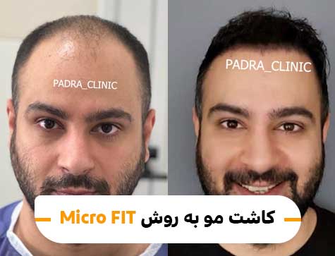 کاشت مو به روش Micro FIT (MFIT)