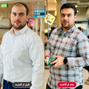 کاشت مو در بندرعباس - کلینیک پادرا