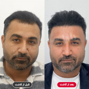 کاشت مو طبیعی در بندرعباس - کلینیک پادرا