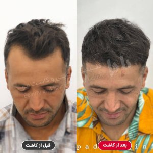 کاشت مو طبیعی در بندرعباس